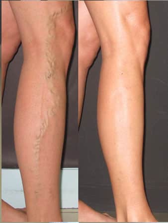 venas-varices