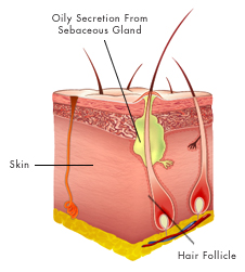 acne.jpg
