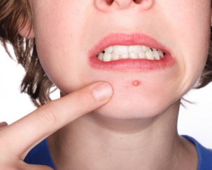acne_conglobata.jpg