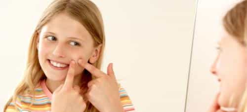 Cómo prevenir el acné adolescente