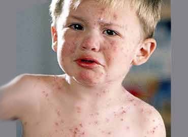 Enfermedades infantiles: la varicela