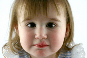 Herpes labiales en los niños