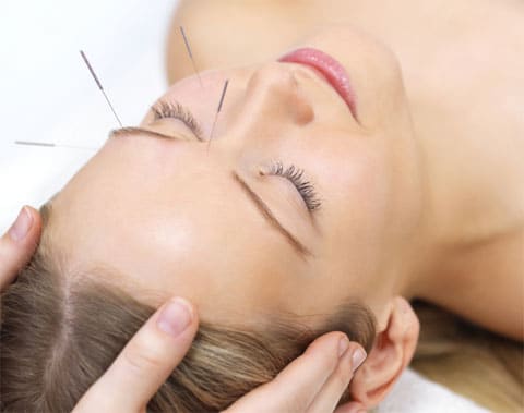 Los beneficios de la acupuntura