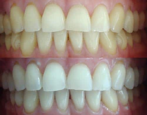 Soluciones naturales para obtener dientes blancos