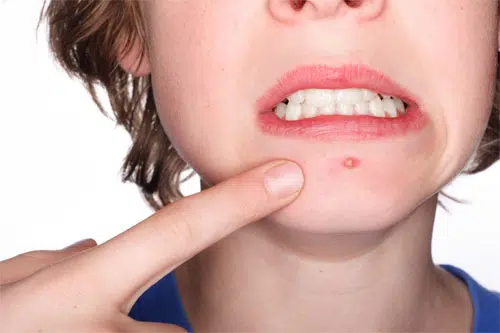 Acné,¿ un problema sólo de adolescentes?