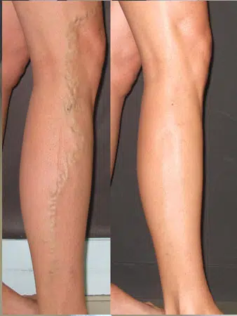 Venas varices